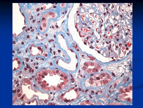 UKidney - Highly active anti-retroviral therapy complications: a ...