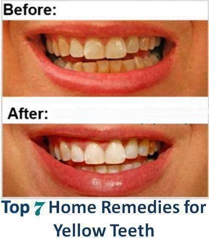 Top 7 Home Remedies for yellow Teeth