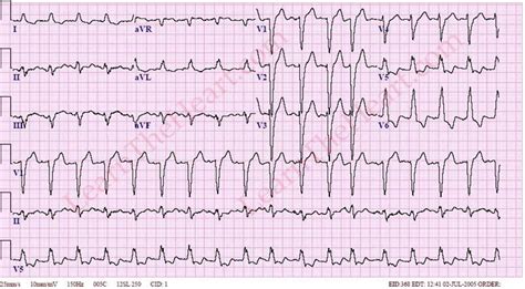 Left Bundle Branch Block ECG 5 | LearntheHeart.com