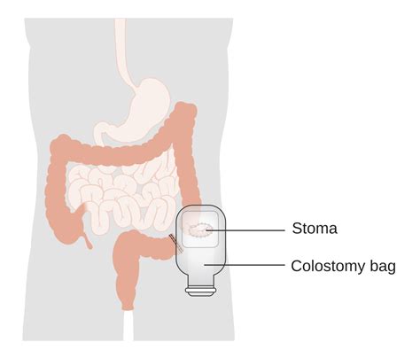 Ileostomy Diagram - Wiring Diagram Pictures