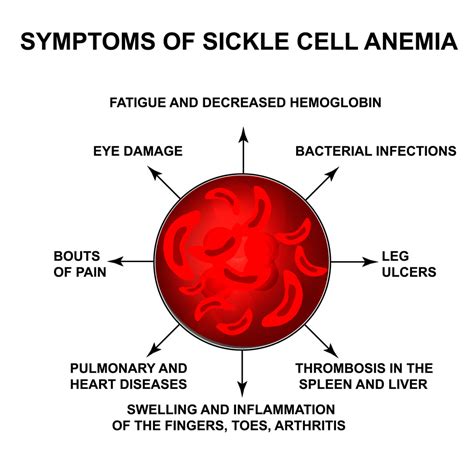 Sickle Cell Anemia and Vision | National Sickle Cell Month - Kadrmas ...