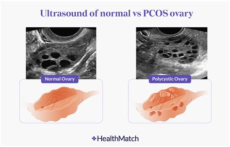 Normal Vs Polycystic Ovaries Ultrasound