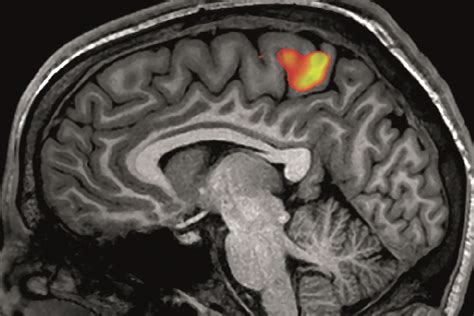 Brain scans predict placebo responses in chronic pain patients - The ...