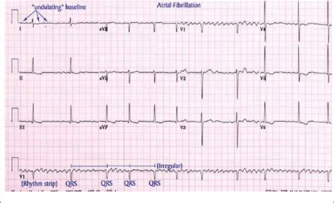 Atrial Fibrillation Ekg Examples