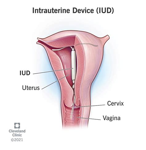 Intrauterine Device (IUD): Birth Control, Use & Side Effects