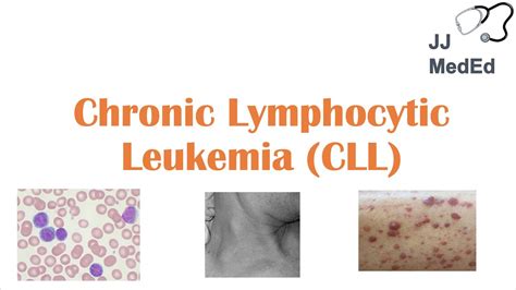 Chronic Lymphocytic Leukemia (CLL): Symptoms (ex. Skin Blisters ...