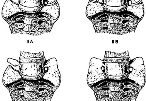 Skull and Spine: Lumbosacral transitional vertebrae