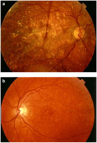 Basal laminar drusen and atrophic maculopathy in patient 2 in 2003. (b ...