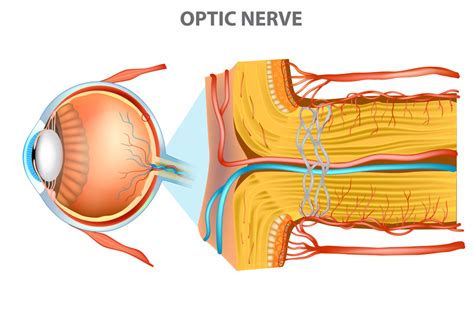 Optic Nerve Swelling (Papilledema) - Harvard Health