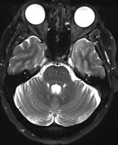 Staphyloma - Neuro MR Case Studies - CTisus CT Scanning