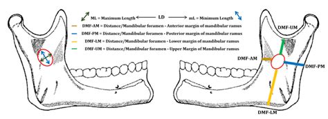 Scheme of the studied distances of the mandibular foramen in relation ...