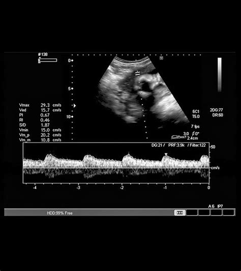 7 Week Ultrasound Heartbeat