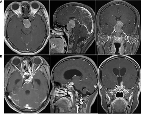 Pituitary Mri