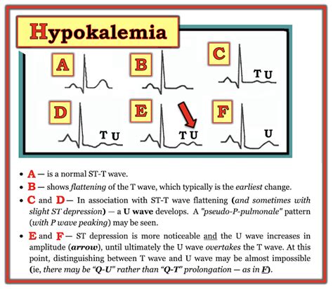 Dr. Smith's ECG Blog: Adding to the many faces of Hypokalemia....