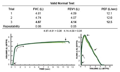 Spirometry EKG Interpretation | EKG.Academy