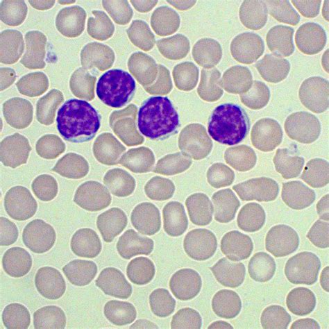 Atypical Lymphocyte