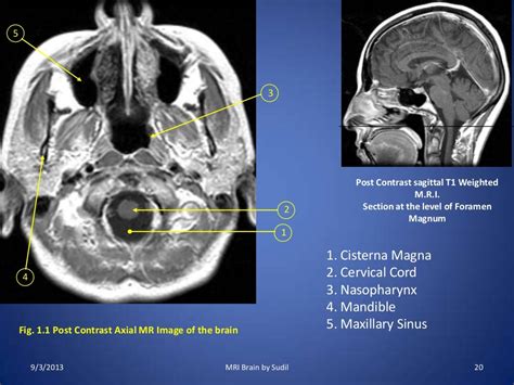 MRI Procedure of Brain