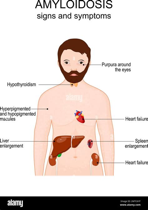 Amyloidosis. Signs and symptoms. Human body with Purpura around the ...