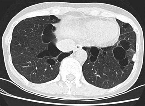 Diffuse Cystic Lung Diseases | Respiratory Care