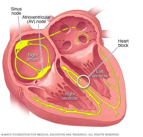 Bundle branch block Disease Reference Guide - Drugs.com