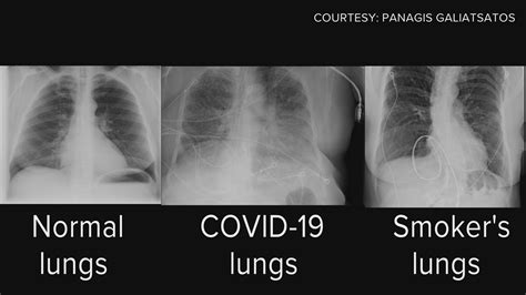 Covid lungs vs smoking lungs: Long term effects of covid on lungs ...