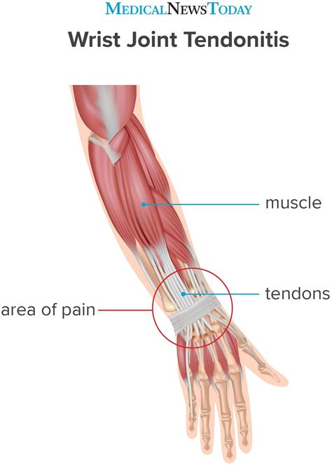 Tendinitis Of Wrist Causes Symptoms Risk Factors And More | Porn Sex ...