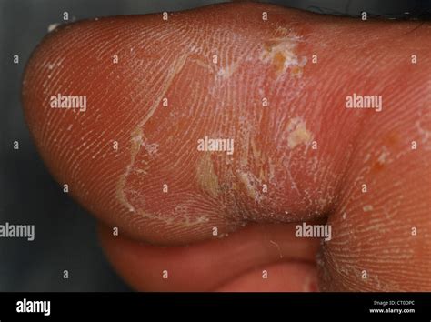 DESQUAMATION OF THE SKIN Stock Photo - Alamy