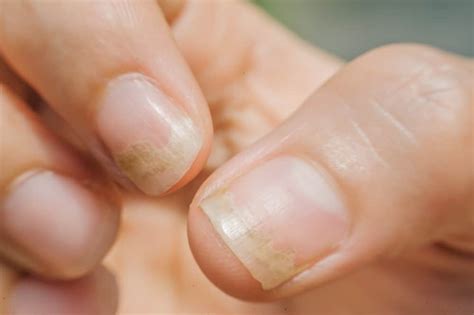 Nail Fungus Treatment, Causes & Symptoms | Clear Out Fungus