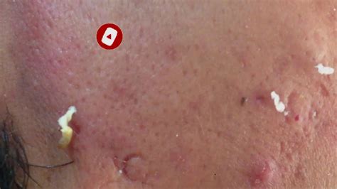 |Blackheads Extraction| |Blackheads Removal| |dr pimple popper office ...