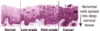 Resultados anormales de la prueba de Papanicolaou: Kimmel Cancer Center ...