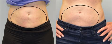 CoolSculpting Before and After Picture of Lower Abdomen - Connecticut ...