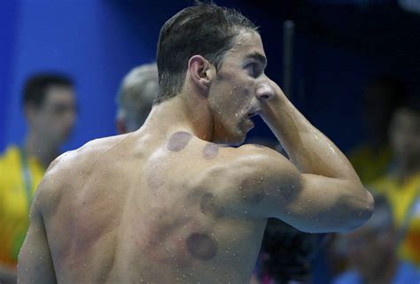 Michael Phelps and the Great Cupping Debate: Why the Olympic Gold ...