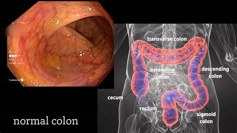 Colonoscopy: A Journey Though the Colon and Removal of Polyps - YouTube