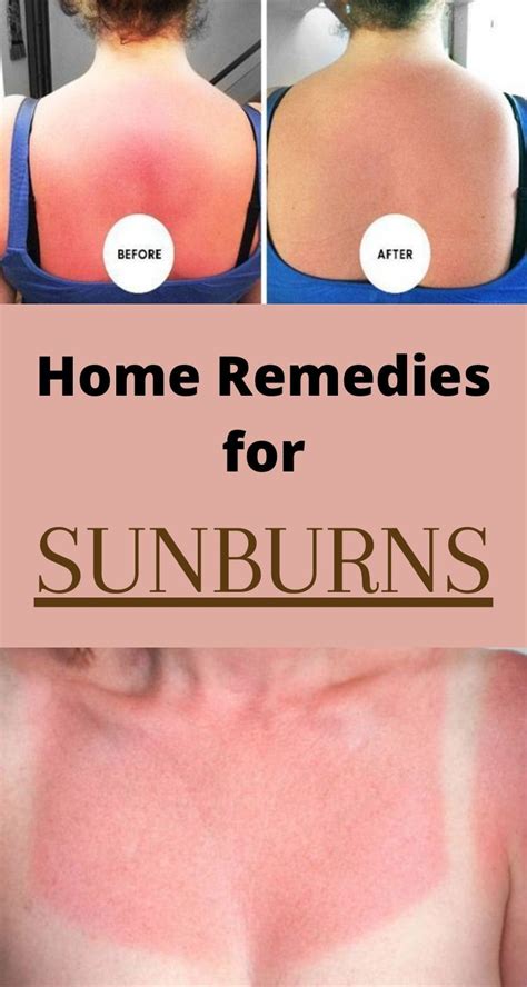 How to get rid of Sunburns Fast with Home remedies and Treatments ...