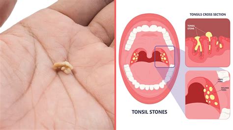 What Are Tonsil Stones?