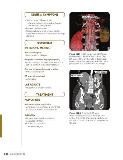 Renal artery stenosis: Video, Causes, & Meaning | Osmosis