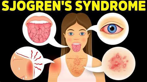 The Best Protocol for Sjogren's Syndrome - YouTube