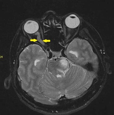 Optic Neuritis Mri