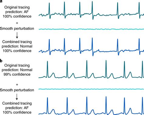 Normal Ecg Tracing