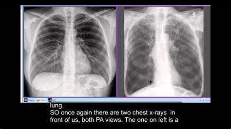 Unhealthy Lungs X Ray