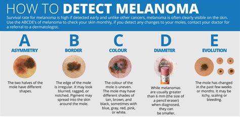 The Weather Network - How to detect melanoma using the ABCDE method