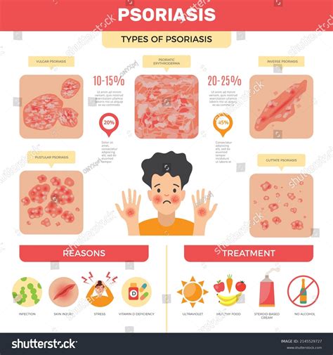 Psoriasis Infographic Human Skin Infection Psoriasis Stock Illustration ...