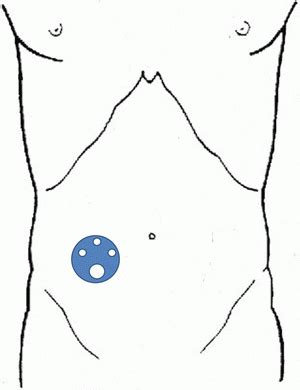 Laparoscopic Stoma Reversal | Abdominal Key