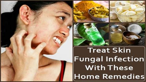 Effective Home Remedies To Treat Skin Fungal Infection - Boldsky.com