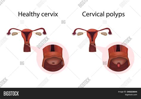 Cervix Polyps Healthy Image & Photo (Free Trial) | Bigstock