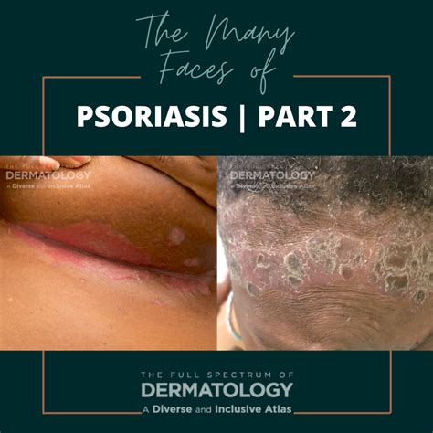 granular parakeratosis Archives - Next Steps in Dermatology