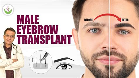 Male Eyebrow Transplant (आईब्रो ट्रांसप्लांट) Procedure in Delhi | Care ...