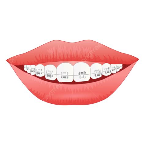 Beautiful White Teeth With Braces Smile, Smile, White Teeth, Braces PNG ...