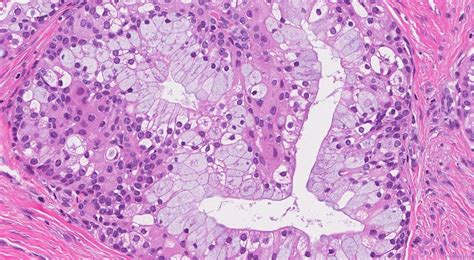 Mucoepidermoid carcinoma | Ottawa Atlas of Pathology