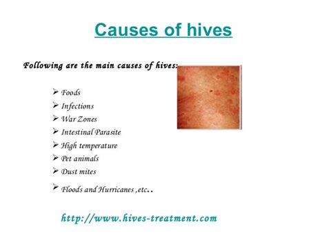 Hives treatment